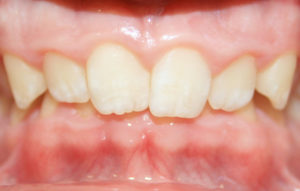 Imagen antes del tratamiento con ortodoncia para corregir la mordida de nuestro paciente Borja.