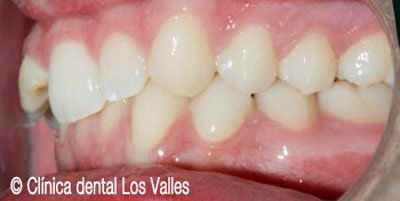 Imagen antes del tratamiento con ortodoncia para corregir la compresión y la sobremordida.