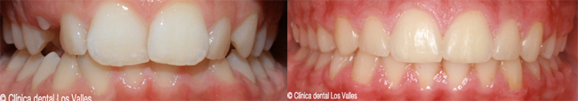 Imagen final de la ortodoncia Damon de neustra clínica dental en Guadalajara, tratado por nuestra ortodoncista la Dra. María Hernández.