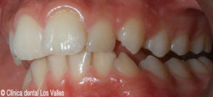 Imagen antes del tratamiento con ortodoncia Damon.