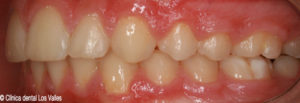 Imagen después del tratamiento con ortodoncia Damon.