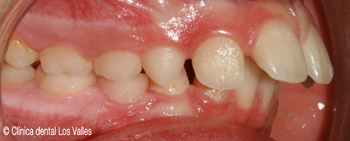 Imagen antes del tratamiento con ortodoncia infantil