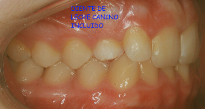 Imagen antes de la cirugía de la fenestración de los dientes incluidos, paciente de la Clínica dental Los Valles en Guadalajara. 