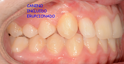 Imagen después de la cirugía de la fenestración de los dientes incluidos, paciente de la Clínica dental Los Valles en Guadalajara. 