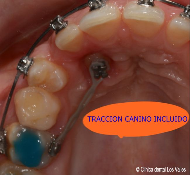 Imagen de un pacientes con fenestración de los dientes incluidos, paciente de la Clínica dental Los Valles en Guadalajara. 