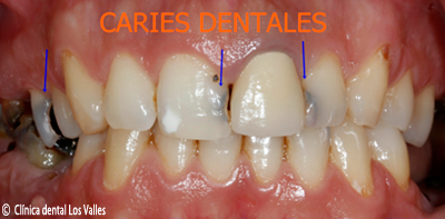 caries-dental