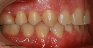 Imagen lateral después del tratamiento de diastema de Clínica Dental Los Valles de Guadalajara.
