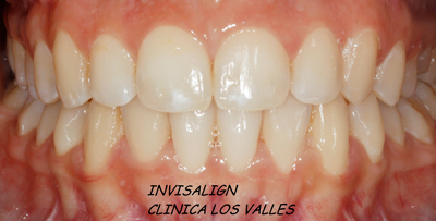 ortodoncia-invisible-invisalign
