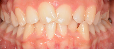tratamiento-ortodoncia-invisible-guadalajara ortodoncia-invisible-invisalign2