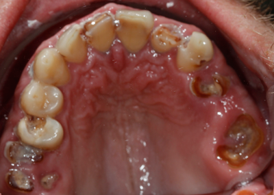 Imagen antes de ser tratado por implantes dentales Straumann, por nuestros implantólogos de Clínica Dental Los Valles de Guadalajara, tras una caries avanzada por diente podrido por dentro.