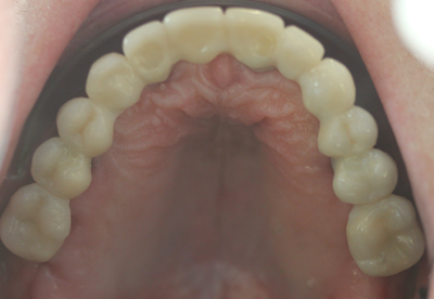Imagen después del tratamiento con implantes dentales Straumann por nuestros expertos de Clínica dental Los Valles de Guadalajara, por caries avanzada por diente podrido por dentro.