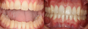 ortodoncia-invisalign-lite