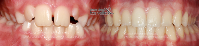 disyuntor-dental-caso-clinico disyuntor-dental-2 expansor