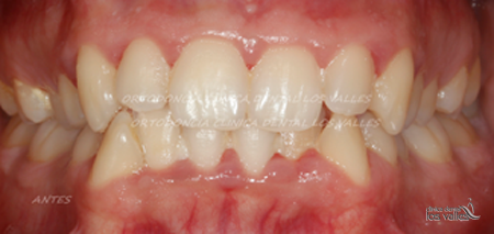 El apiñamiento de los dientes y la mala posición dentaria, tanto del maxilar superior como de la mandíbula, suelen producir un efecto secundario. Este problema produce el sangrado de encías y su recesión porque se forman recovecos entre los dientes, imposibles de limpiar.