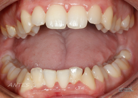 Hoy os enseñamos el caso clínico de un paciente resuelto en nuestra clínica dental en Guadalajara. Y, ¿qué problema dental tenía? Nuestro paciente acudió con una inflamación y un sangrado general en toda la boca que estaba provocado por un apiñamiento dental. Además, y como se observa en las fotografías, la arcada era muy estrecha y los caninos o colmillos inferiores estaban totalmente girados fuera de la arcada.