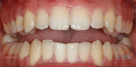 En tan solo 18 meses, y sin extracciones, nuestro paciente había pegado un cambio espectacular. Por un lado, se consiguió centrar las líneas media, diseñando una sonrisa amplia, con un engranaje perfecto y el sangrado, con unas encías mucho más sanas y desinflamadas.