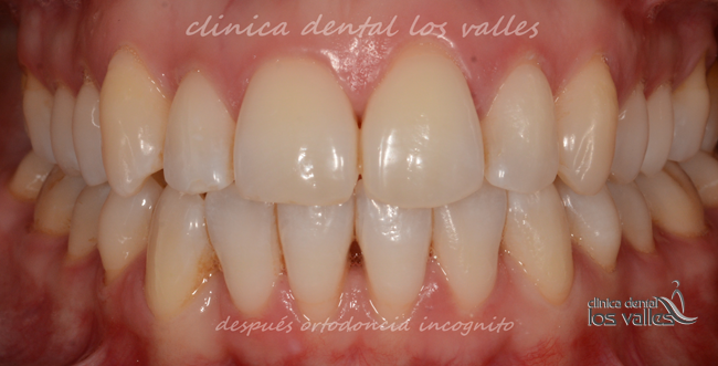 El paciente demandaba un tratamiento estético de ortodoncia. Y se planificó solucionar sus problemas con brackets transparentes. Tras dos años de mucho trabajo, se consiguió un cambio espectacular con una sonrisa mucho más bonita y amplia.