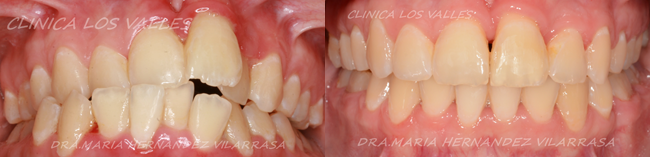 Las primeras revisiones de odontopediatría y aquellas pediátricas deben ir de la mano. Por esta razón, siempre recomendamos una primera revisión de tu bebé para confirmar su buen estado oral o en la mejora de su dentición con tratamientos odontopediátricos. En nuestra clínica dental, el equipo de la Dra. María Hernández es el encargado de aquellos tratamientos de ortodoncia infantil.