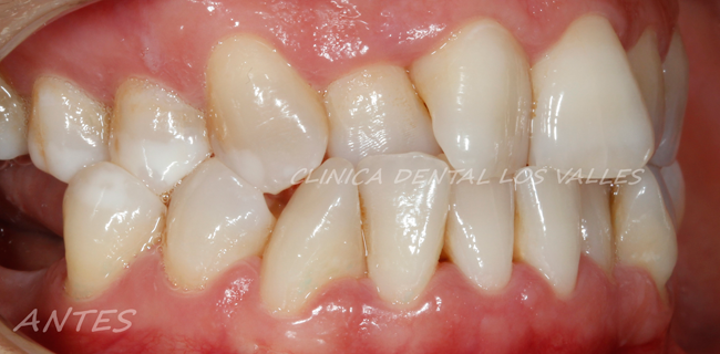 La mordida cruzada es una malposición o maloclusión dentaria que sucede cuando los dientes del maxilar superior engranan por dentro de los inferiores.