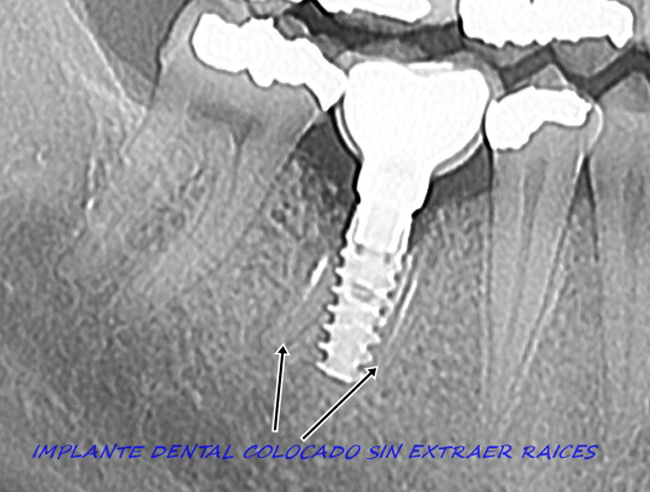 Caso clínico defectuoso en implantes dentales en Guadalajara.