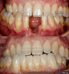 Una de las preguntas más recurrentes en nuestra clínica es por qué los implantes dentales se caen. Recuerda que el implante en sí mismo no produce rechazo porque su material es biocompatible con tu organismo.