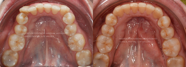 Caso de éxito de mordida cruzada con ortodoncia incognito de Clínica dental Los Valles de Guadalajara.