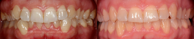 Caso de éxito con mordida cruzada con ortodoncia incognito en Clínica dental Los Valles de Guadalajara.