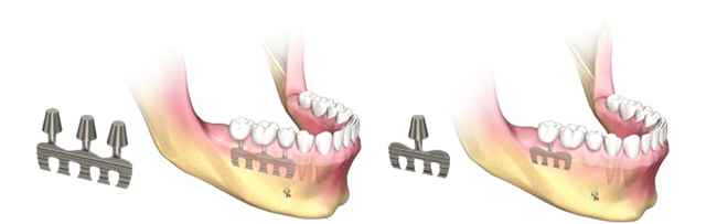 implantes dentales laminados