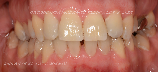 Caso clínico durante el tratamiento de ortodoncia incognito de nuestro paciente de Clínica dental Los Valles.
