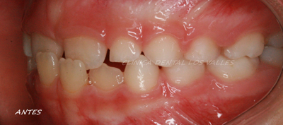 Caso clínico tratado con ortodoncia interceptiva en Clínica dental Los Valles de Guadalajara.