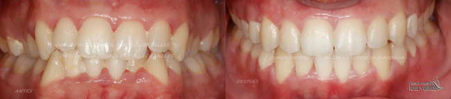 Si tienes alguna dudas o crees tener estos síntomas sobre apiñamiento dental, pide tu cita gratuita con nuestro equipo de ortodoncistas. Para evitar  que el sangrado y la periodontitis lleguen a tus dientes, confía en los expertos.