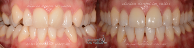 El stripping o reducción interproximal: este procedimiento reduce el ancho de determinadas piezas dentales (entre 0,2 y 0,5 milímetros) para separarlas y ganar así un espacio entre ellas.