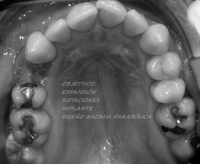 El primer paso fue realizar el cementado de ambas arcada y el protocolo de cambio de arcos secuenciados para realizar los movimientos dentarios. 