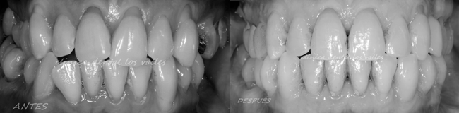 Al finalizar su tratamiento, se cambiaron las fundas provisionales por fundas sobre implantes de circonio estético. Y conseguimos alcanzar todos nuestros objetivos, descruzando la mordida alineando, nivelando las arcadas maxilares y mejorando la estética y su función.