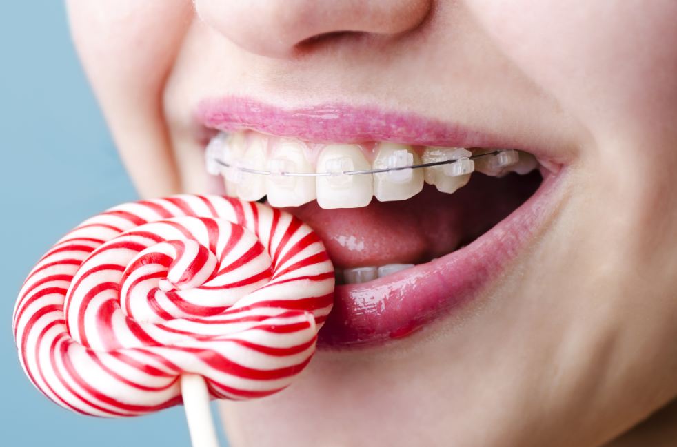 Imagen con tratamiento con otodoncia Damon para tratar el apiñamiento dental.