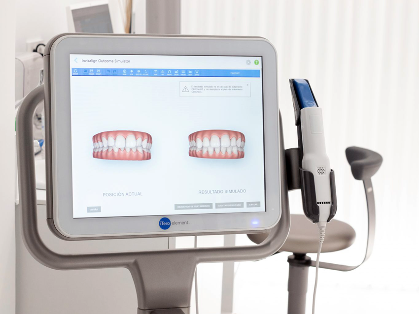 El escáner digital iTero nos ofrece una imagen instantánea en 3D de la boca de nuestros pacientes. Con esta imagen digital, podemos ver el interior de cada boca, así como sus tejidos blandos y la posición de sus dientes.