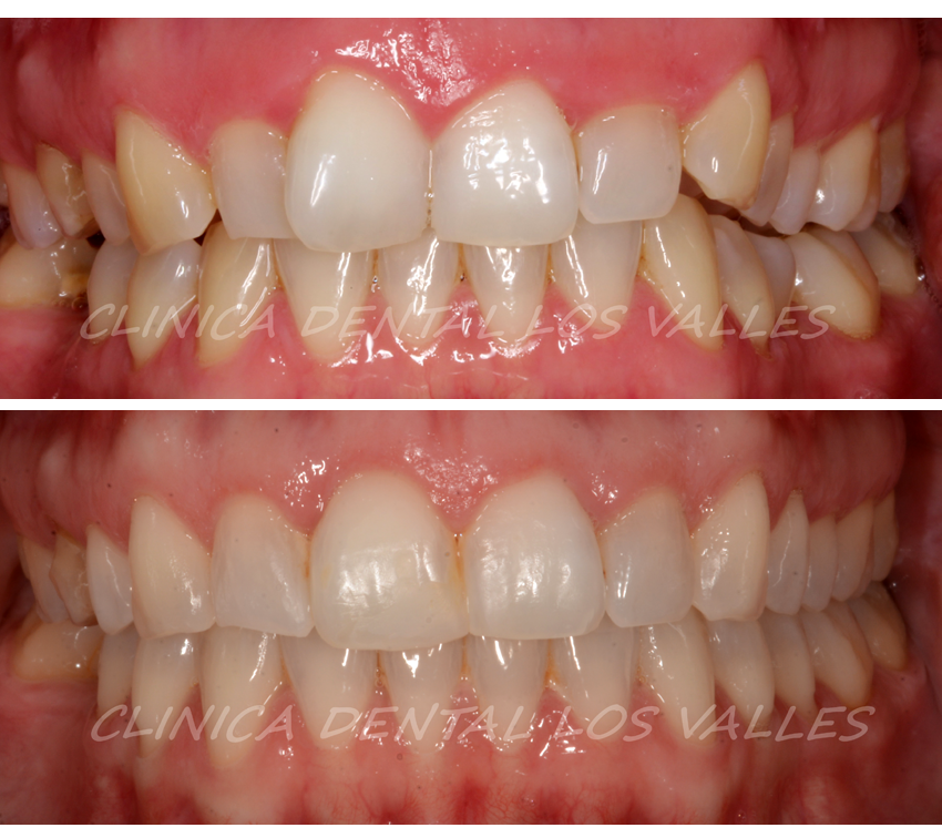 Antes y después del tratamiento de ortodoncia invisible Invisalign en nuestra clínica dental en Guadalajara.