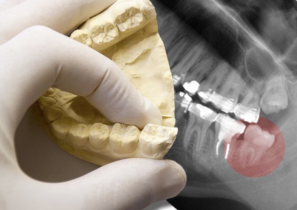 Los morales o muelas del juicio pueden darte problemas en tu boca, sobre todo por el apiñamiento o por algunas molestias y problemas dentales graves, sobre todo si crecen en un ángulo totalmente torcido. 