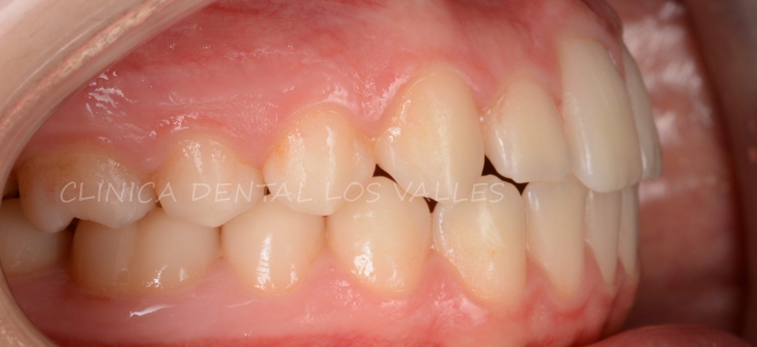 Si lo hubiéramos tratado con brackets, éstos terminarían despegándose poco a poco, sobre todo en los casos infantiles. En este caso, el paciente fue cambiando los aligners cómodamente en casa sin rozaduras durante el  tratamiento para paliar las diademas con ortodoncia Invisalign y bajo la supervisión de nuestros ortodoncistas. 