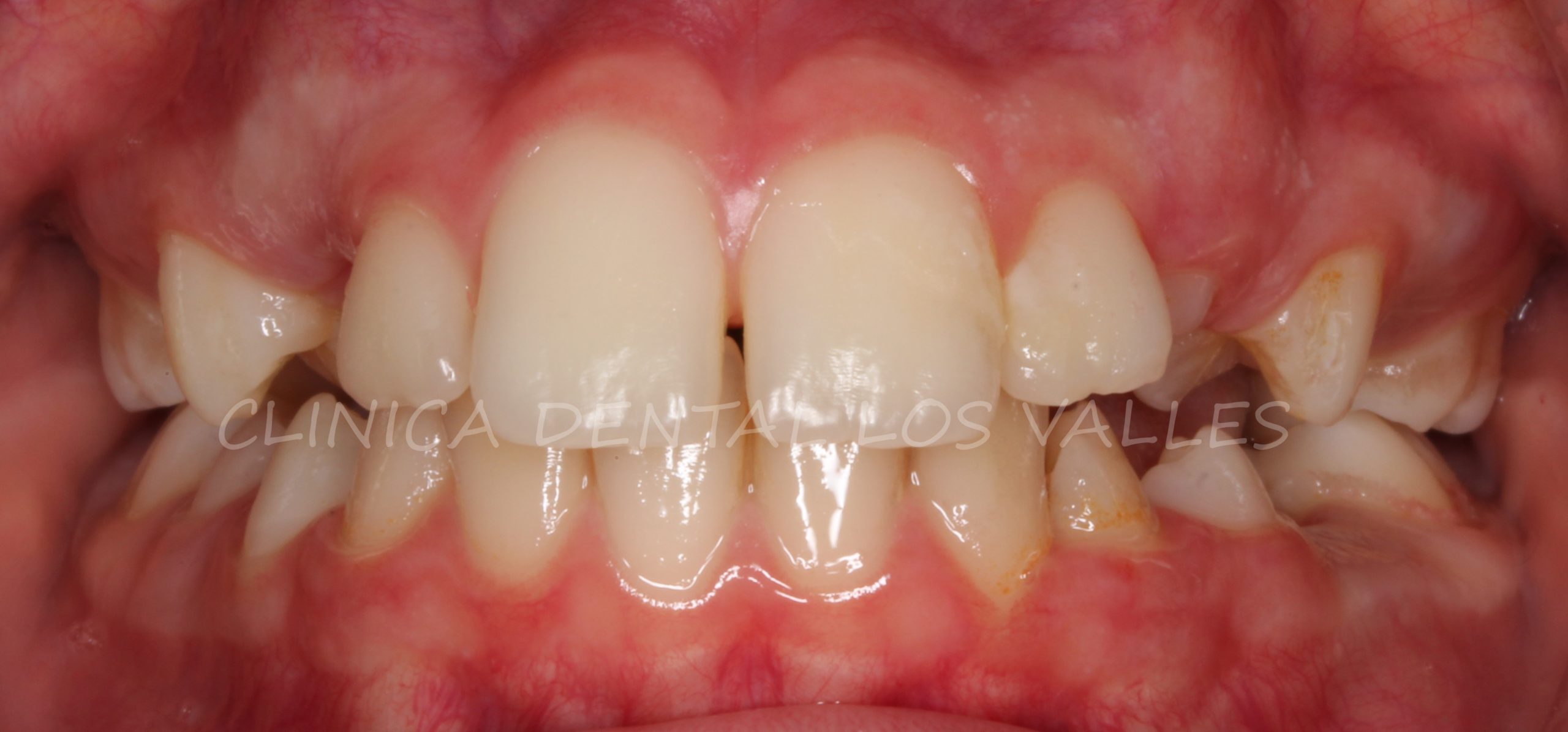 Nuestro equipo de ortodoncia infantil empezó a tratar a nuestro paciente de 10 años con alineadores transparentes para guiar la erupción de los dientes definitivos, corregir la oclusión de los existentes y mejorar las diademas con ortodoncia Invisalign.