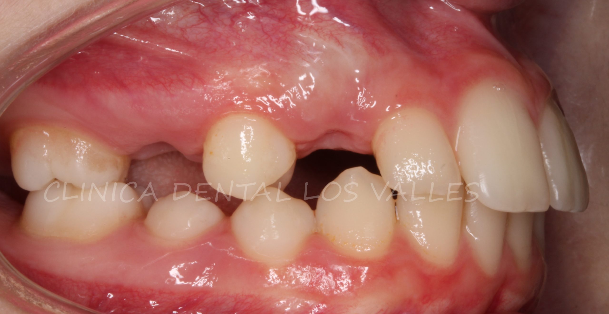 Los alineadores transparentes eran perfectos para nuestro paciente porque podíamos guiar la erupción de los dientes para que fueran a la posición perfecta. Además, gracias a la experiencia de nuestro equipo de ortodoncia con este tipo de aparatos, integramos el diseño estético de la sonrisa para que el resultado final fuera espectacular en las diademas con ortodoncia Invisalign. 