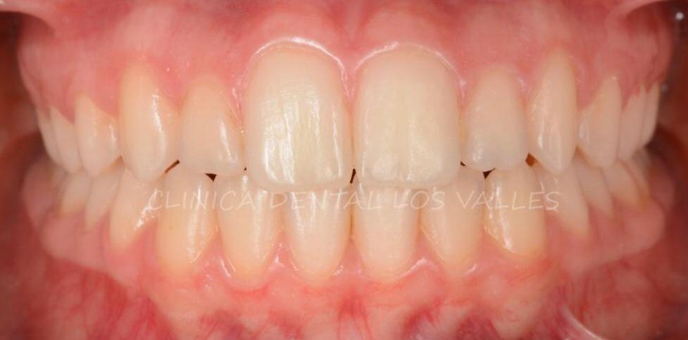 Hoy mostramos un nuevo caso infantil de dientes apiñados y diastemas con ortodoncia Invisalign. Nuestro paciente fue tratado por el equipo de ortodoncia como uno de los casos más completos de los últimos tiempos. Y, gracias a los ortodoncistas infantiles de nuestra clínica dental en Guadalajara, conseguimos un cambio radical.