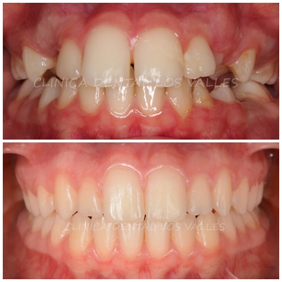Imagen antes y después del tratamiento en ortodoncia, tras las revisiones de tu salud bucodental. 