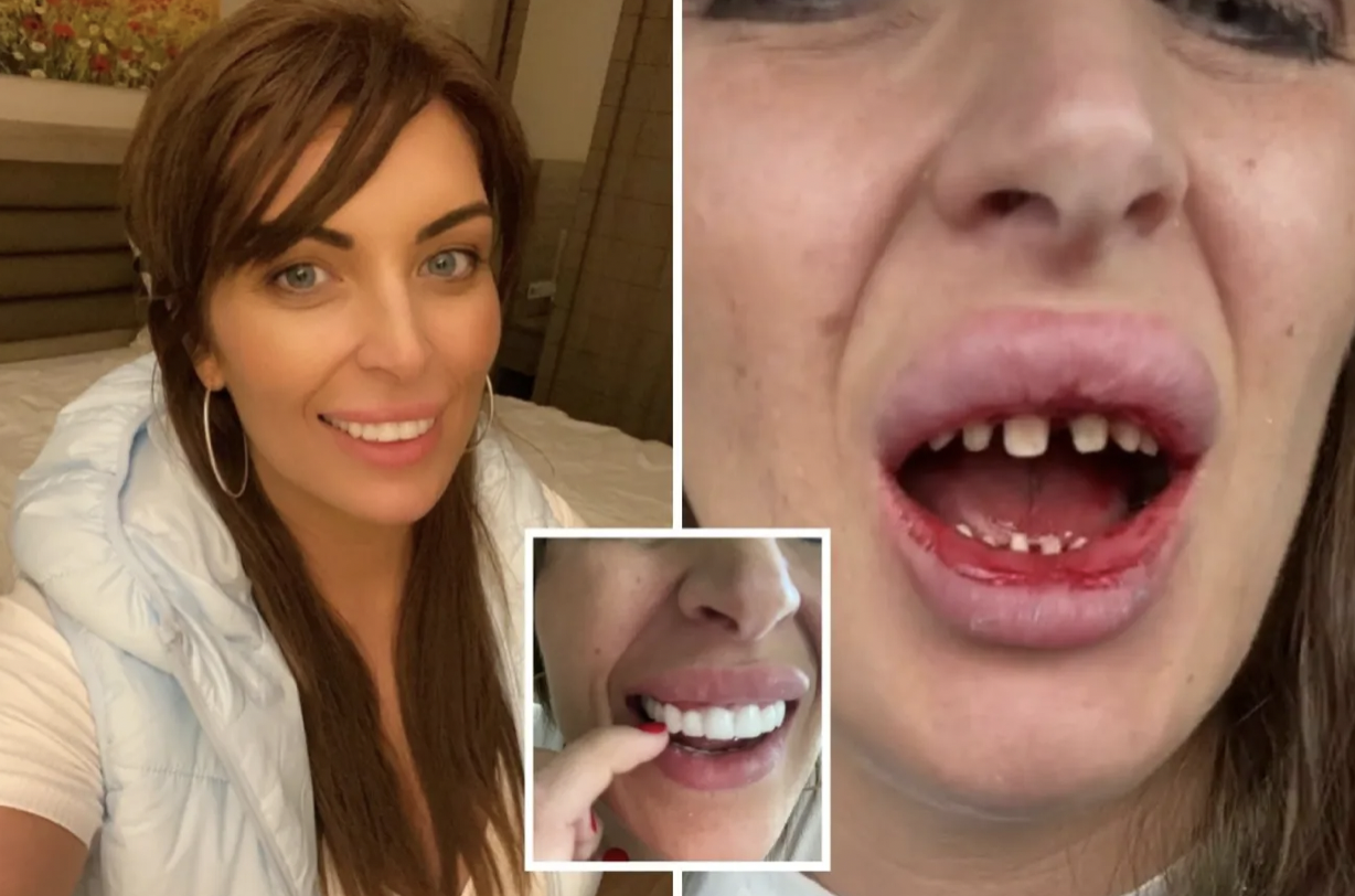 La mala gestión del TurkeyTeeth puede causar daños en el nervio dental, dolor, infección, abscesos, pulpitis e incluso la pérdida del diente.