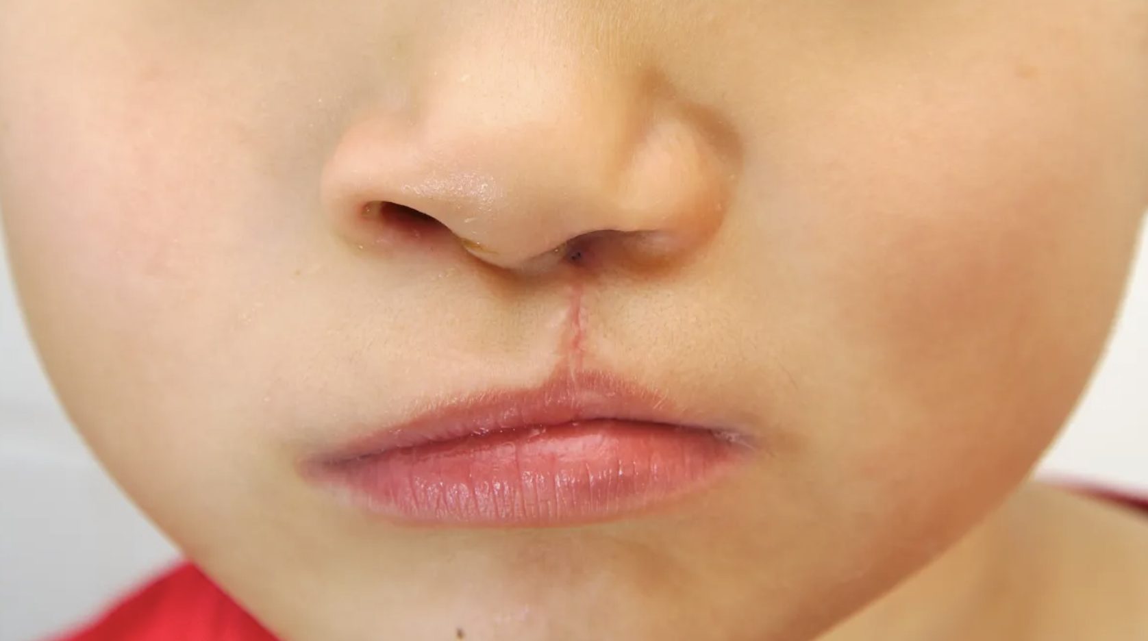 El paladar hendido, hendidura del paladar, y el labio leporino están relacionadas. Se trata de un defecto que comienza en el feto, y que en su nacimiento muestra una fisura en el labio superior, en el techo de la boca, o en ambas zonas.