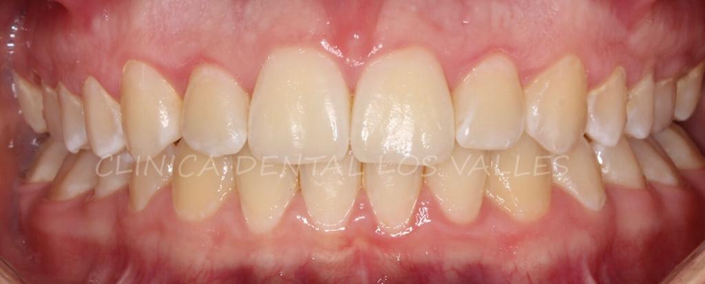 Caso cínico después del tratamiento de ortodoncia para tratar la sobremordida horizontal en Clínica dental Los Valles. 
