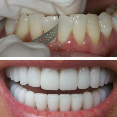 El stripping dental o IPR nos ayuda a conseguir los objetivos de ortodoncia al disminuir el esmalte dental de nuestros pacientes en Clínica dental Los Valles de Guadalajara.