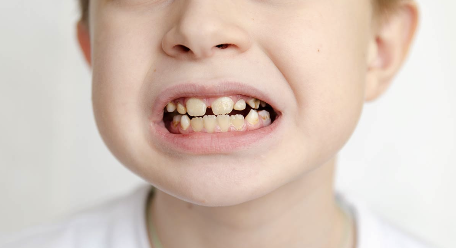 Los dientes de tiza o dientes calcáreos es una afección dental que se produce en uno de cada cinco niños en todo el mundo. Este problema oral se forma a través de la hipomineralización molar (MH) y provoca caries y un gran dolor en sus muelas, entre otros síntomas.
