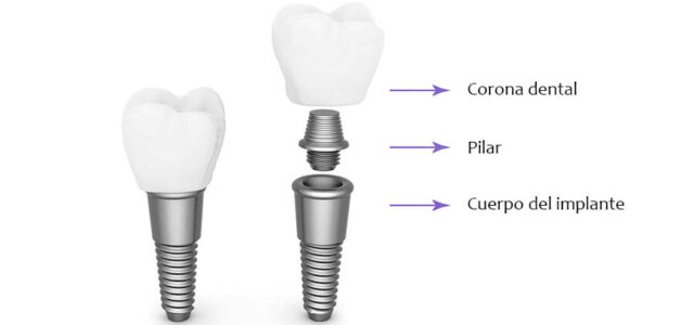 Si te decides con el tratamiento en implantes inmediatos, debes consultar con un experto en los tratamientos en implantes inmediatos que pueda ofrecerte, según tu caso, la mejor opción en implantología. En nuestra clínica dental Los Valles, el Dr. Iván Arianes y su equipo dental son especialistas con más de 3.000 casos clínicos de éxito.   