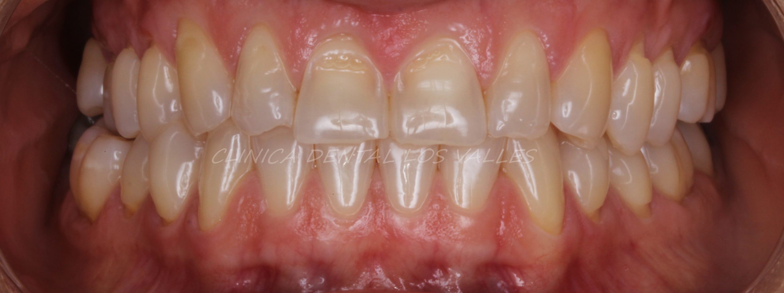 Imagen de casos clínico después del tratamiento de maloclusión con mordida cruzadada, ortodoncia invisible y estética dental. 